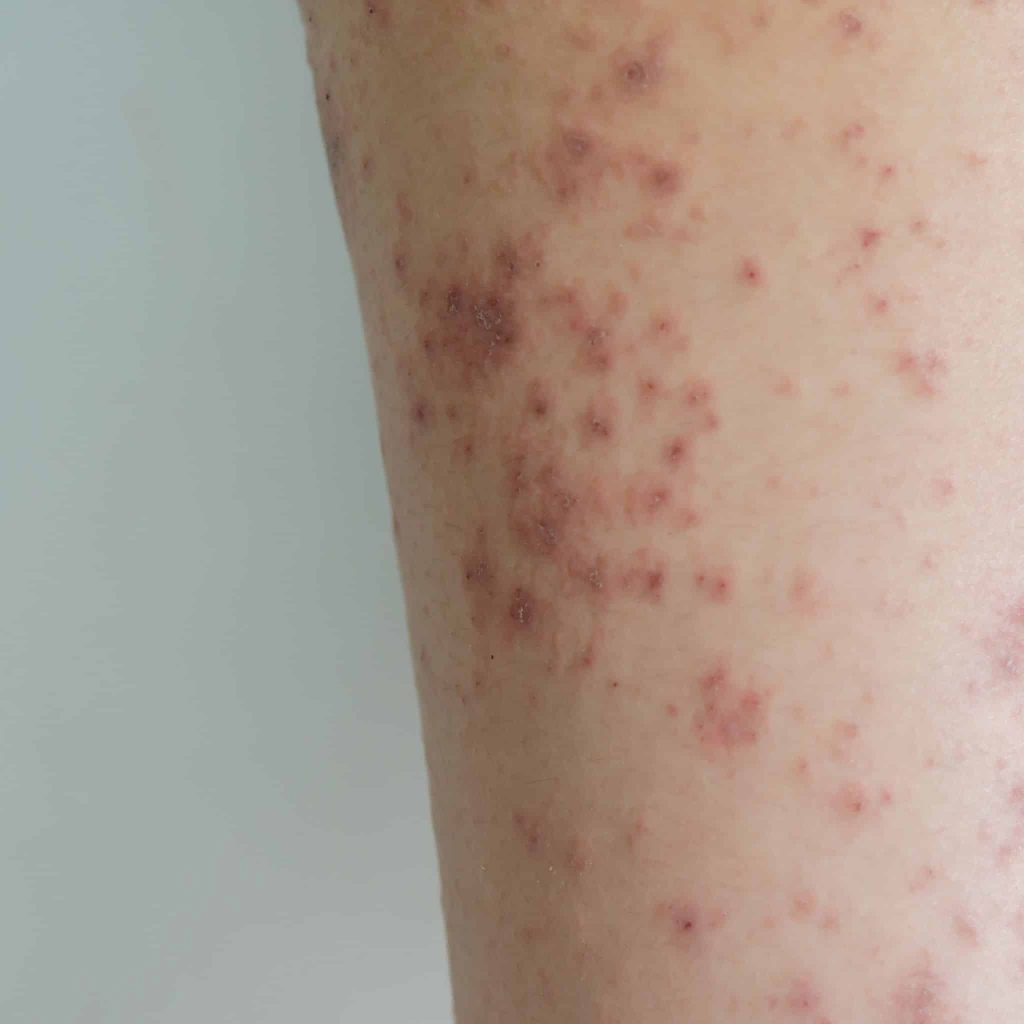 ágyi poloska csípés elvakarva